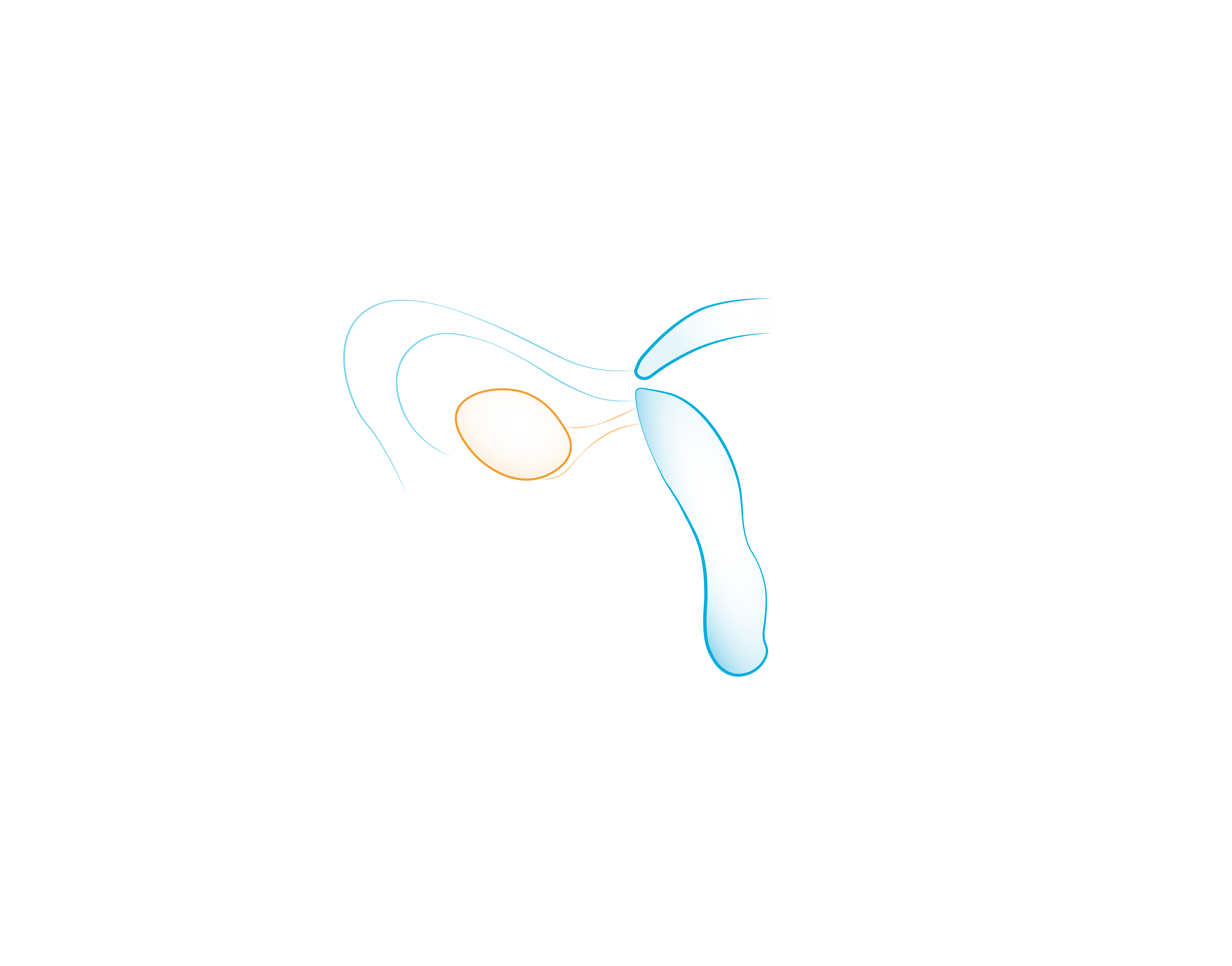Il Tumore dell’Ovaio
