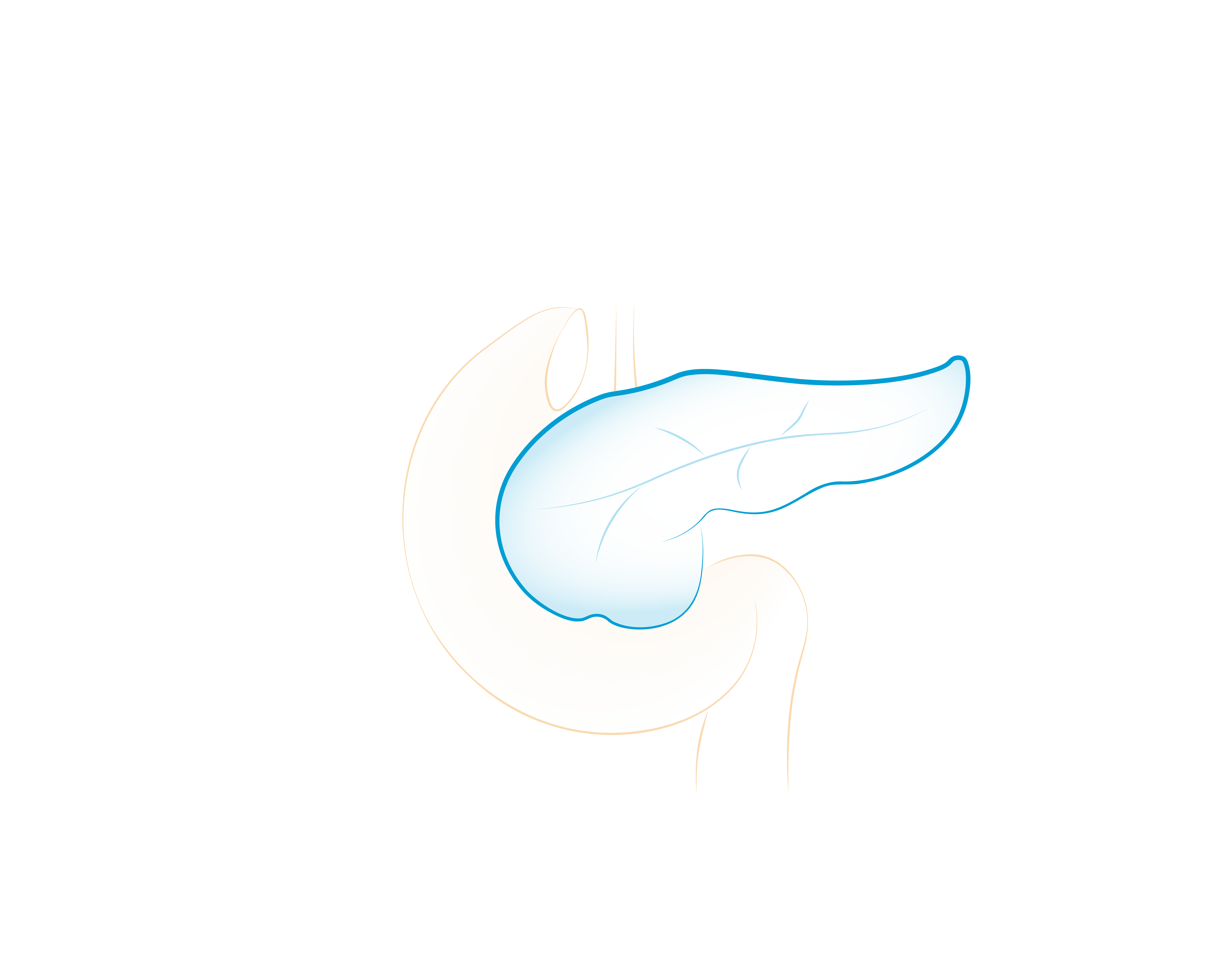 Il Tumore del Pancreas