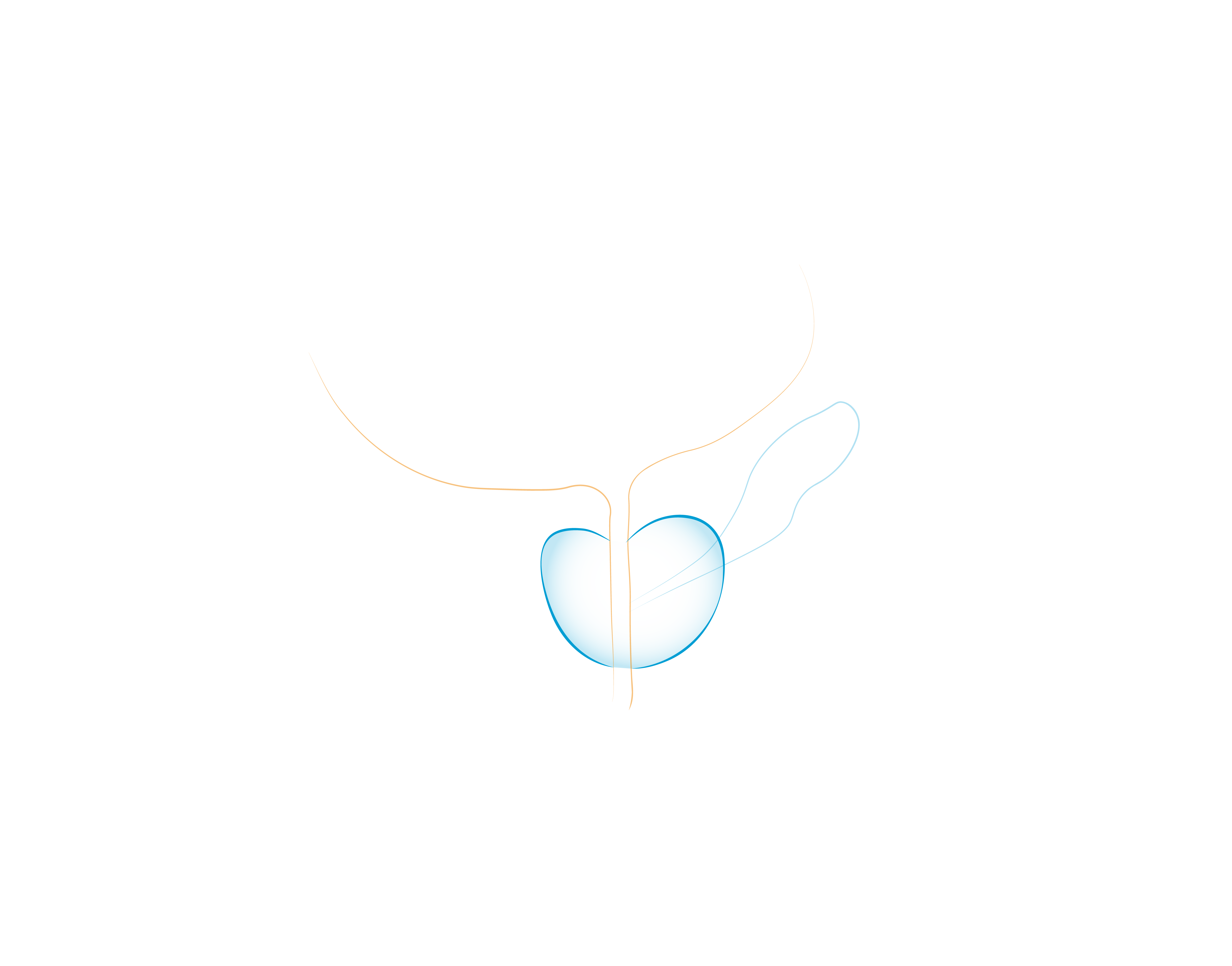 Il Tumore della Prostata